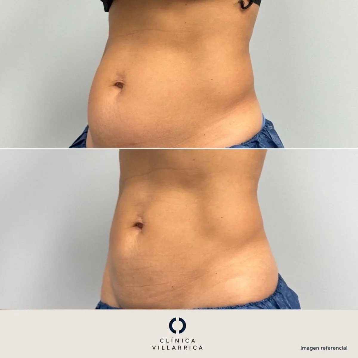 Antes y después de liposucción de abdomen, vista lateral