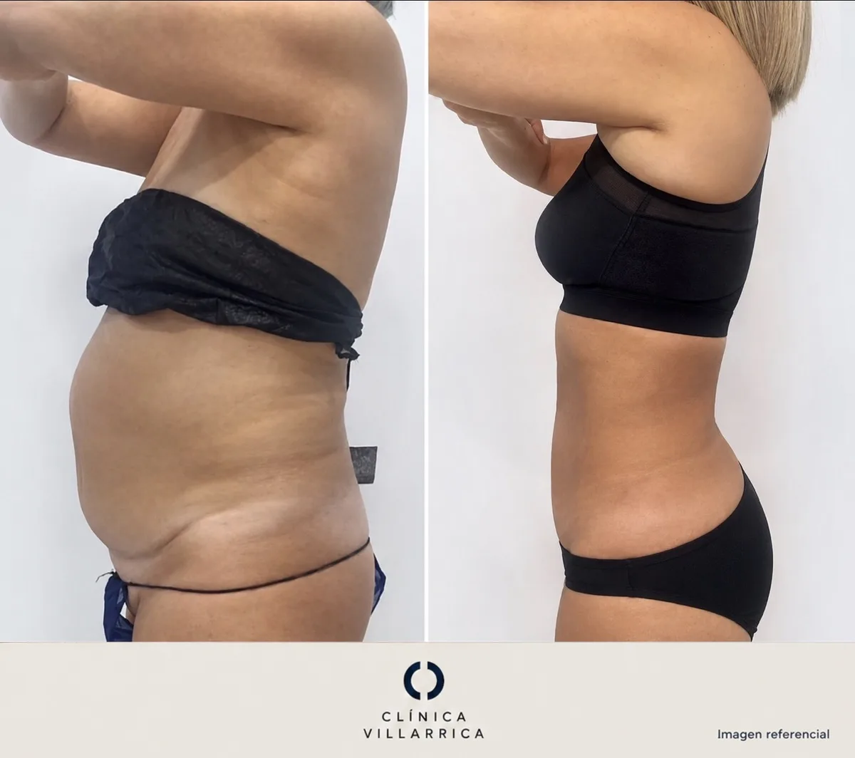 Antes y después de liposucción de abdomen, vista de perfil