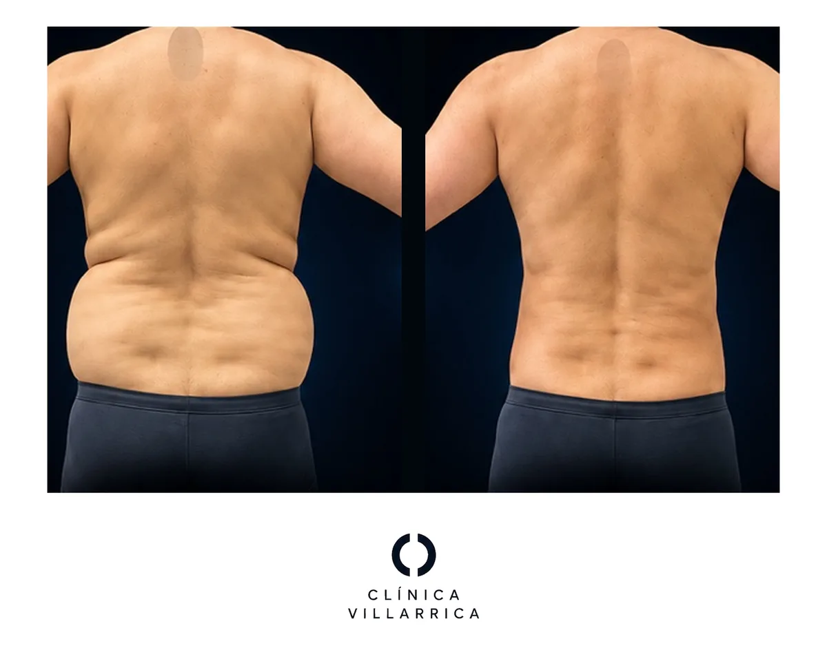 Antes y después de liposucción de dorso y flancos en hombre, vista posterior
