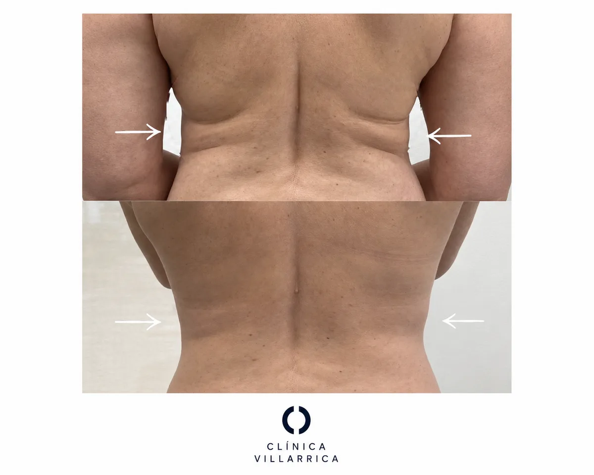 Antes y después de liposucción de dorso y flancos en mujer, vista posterior