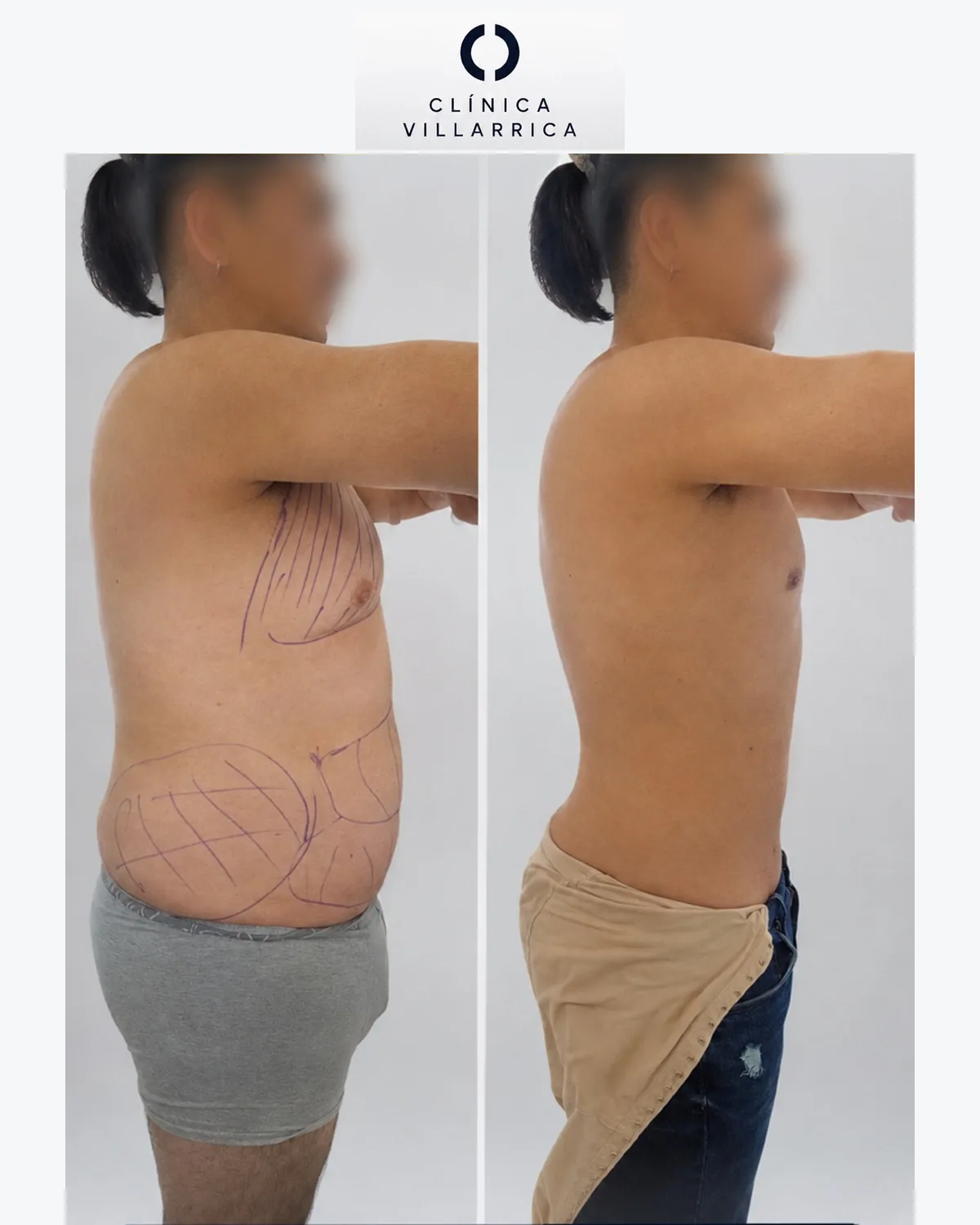 Antes y después de liposucción masculina de torso, vista lateral