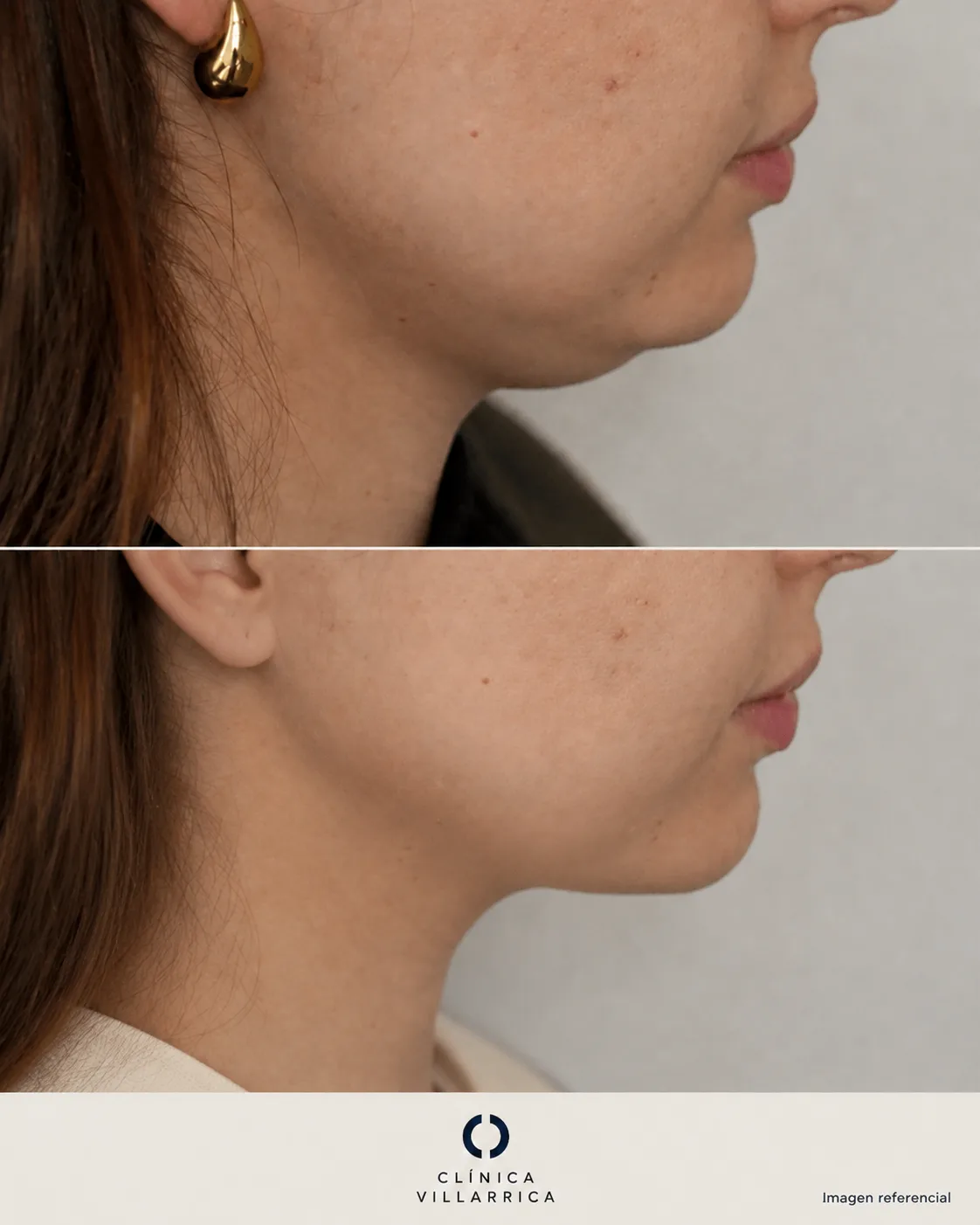 Antes y después de liposucción de papada en mujer, vista de perfil